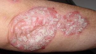 the main manifestations of psoriasis