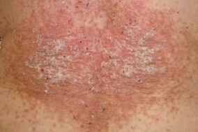 siational stage of psoriasis