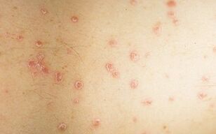 photo of the initial stage of psoriasis