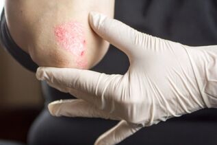 Psoriasis treatment principles