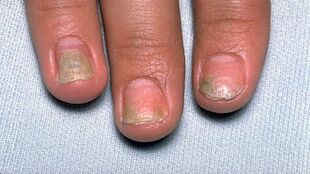 causes of psoriasis on the nails