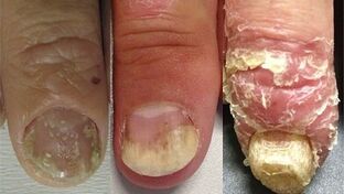 stages of development of nail psoriasis